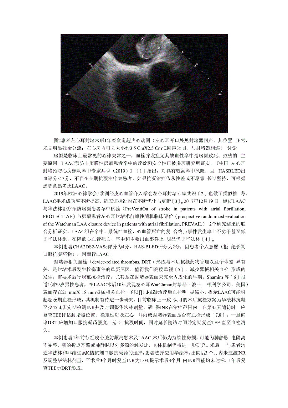 （病例报告）左心耳封堵器血栓两例.docx_第2页