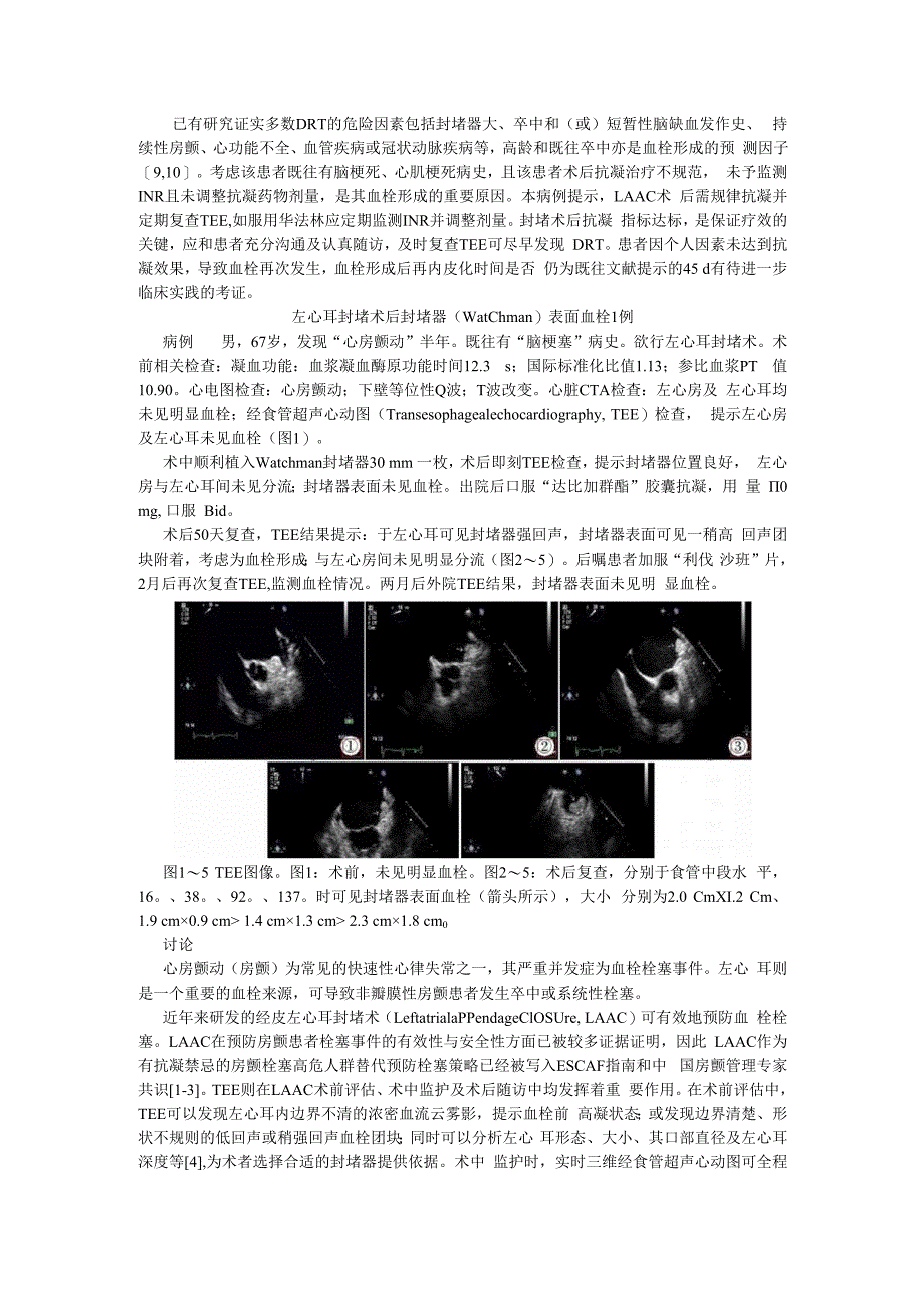 （病例报告）左心耳封堵器血栓两例.docx_第3页